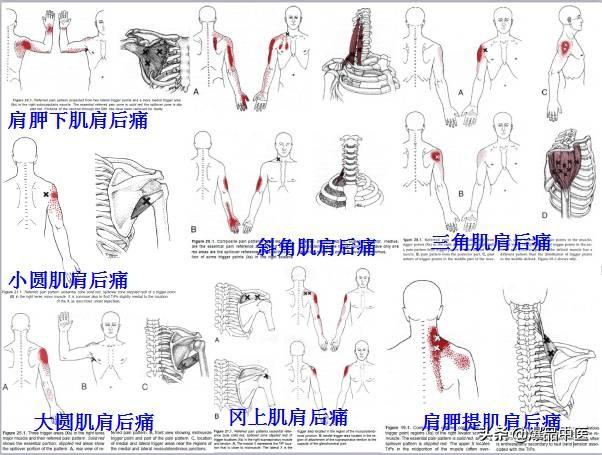 「图文并茂」全身激痛点