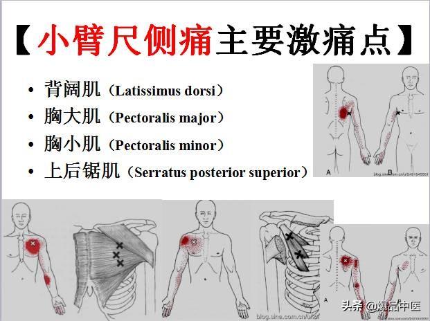 「图文并茂」全身激痛点