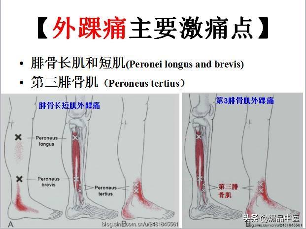 「图文并茂」全身激痛点