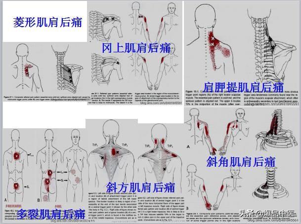 「图文并茂」全身激痛点