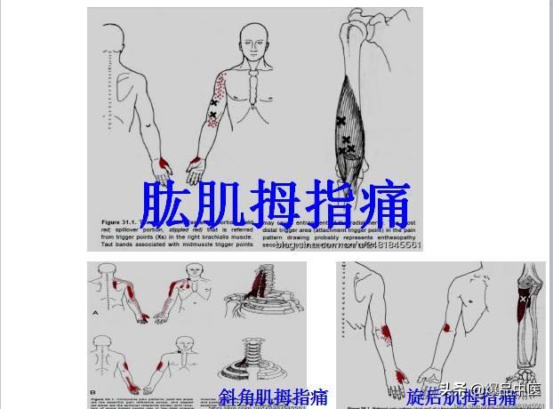 「图文并茂」全身激痛点