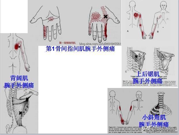 「图文并茂」全身激痛点