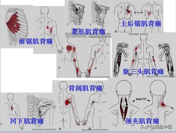 「图文并茂」全身激痛点