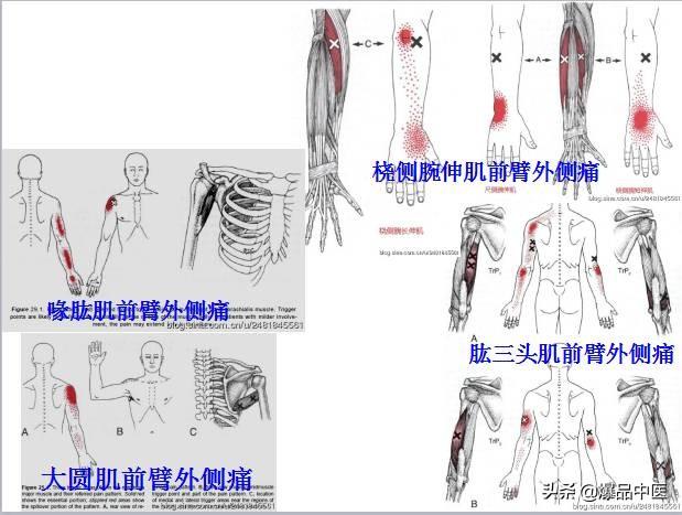 「图文并茂」全身激痛点
