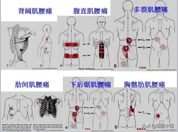 「图文并茂」全身激痛点