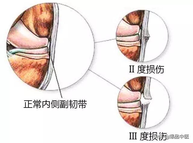 膝关节疼痛一般是什么病？