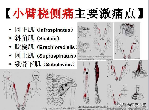 「图文并茂」全身激痛点