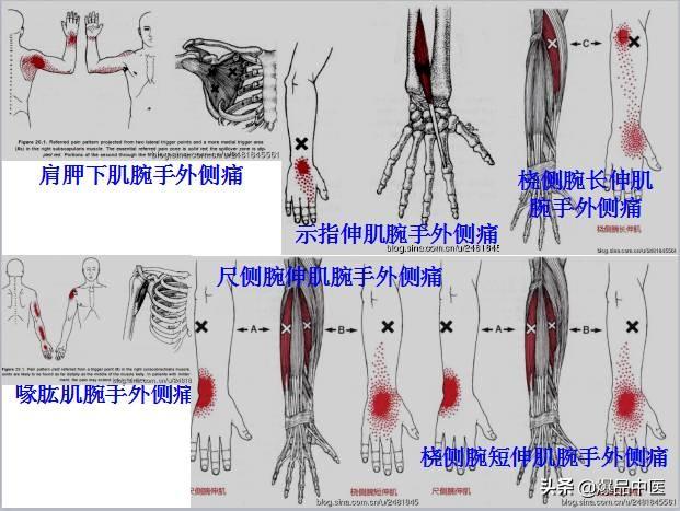 「图文并茂」全身激痛点