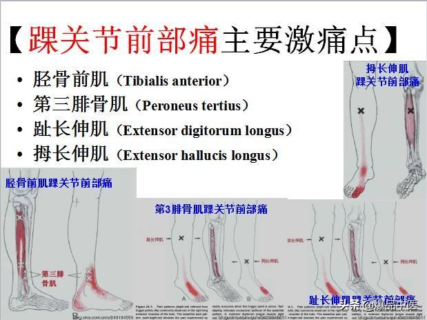 「图文并茂」全身激痛点