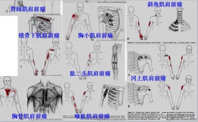 「图文并茂」全身激痛点