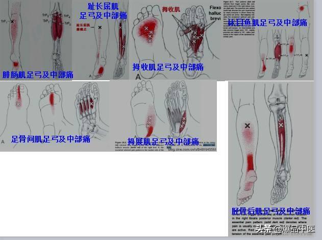 「图文并茂」全身激痛点