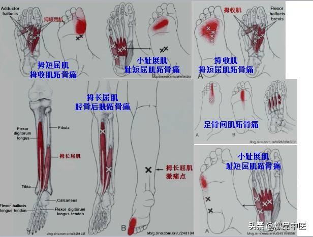 「图文并茂」全身激痛点