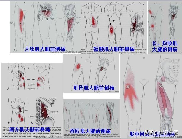 「图文并茂」全身激痛点