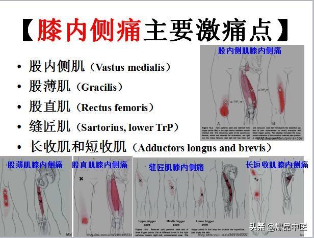 「图文并茂」全身激痛点