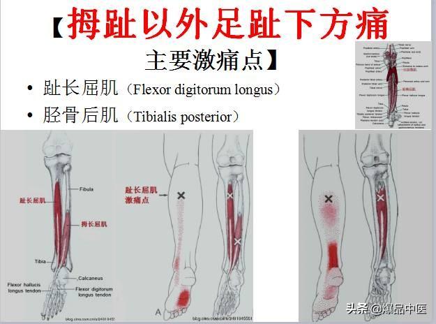 「图文并茂」全身激痛点