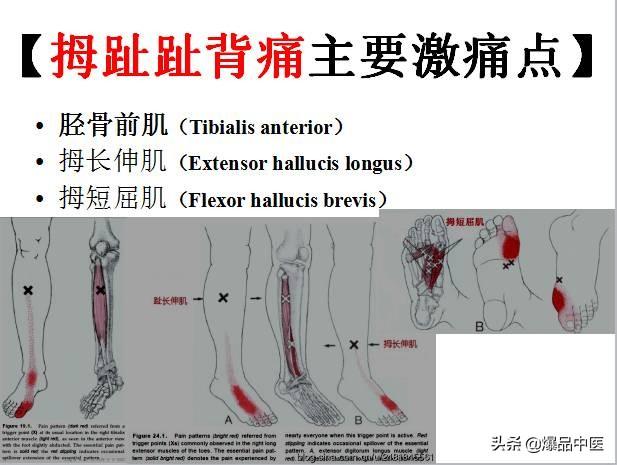 「图文并茂」全身激痛点