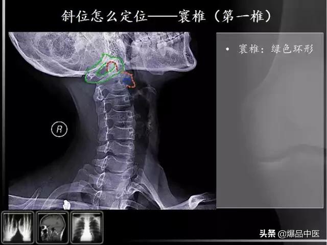 颈椎阅片的基础知识