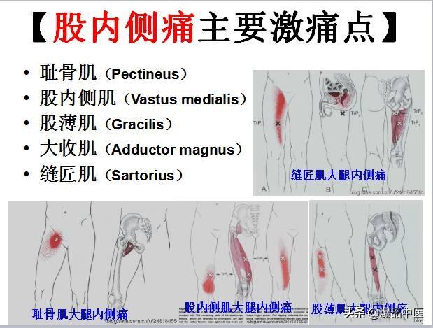 「图文并茂」全身激痛点