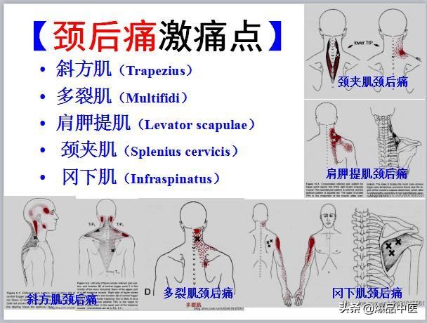 「图文并茂」全身激痛点