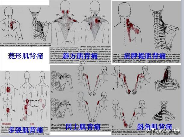 「图文并茂」全身激痛点