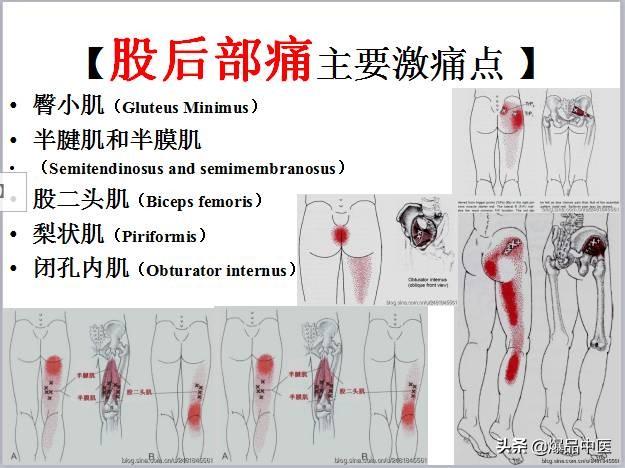 「图文并茂」全身激痛点