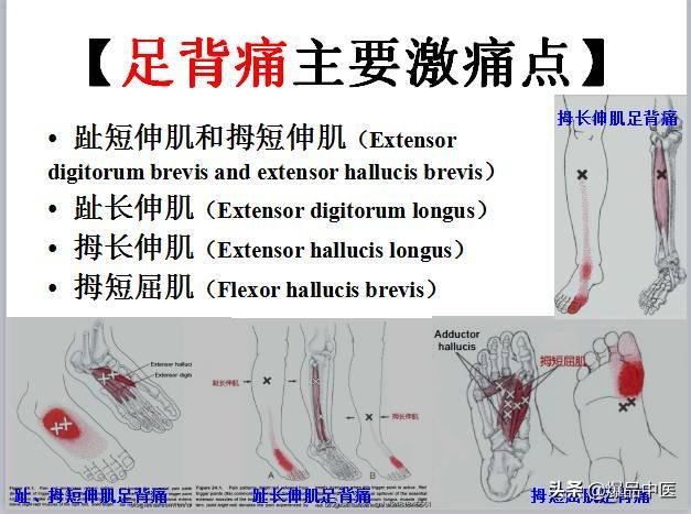 「图文并茂」全身激痛点