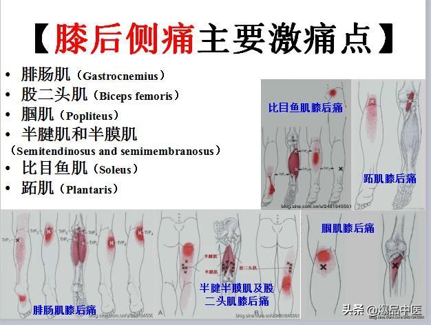 「图文并茂」全身激痛点