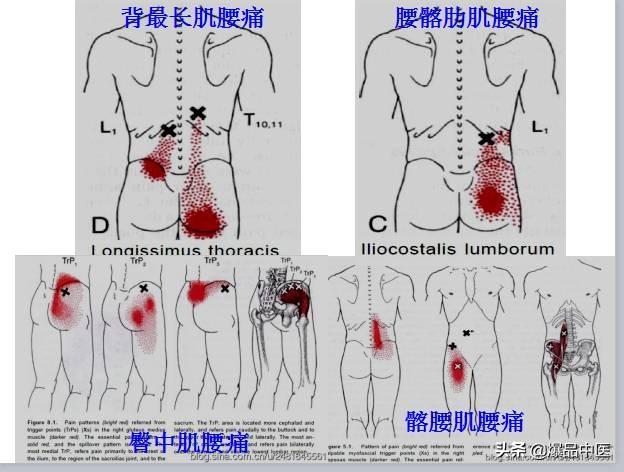 「图文并茂」全身激痛点