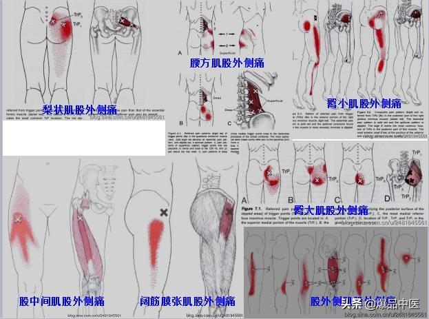 「图文并茂」全身激痛点