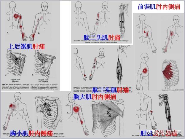 「图文并茂」全身激痛点