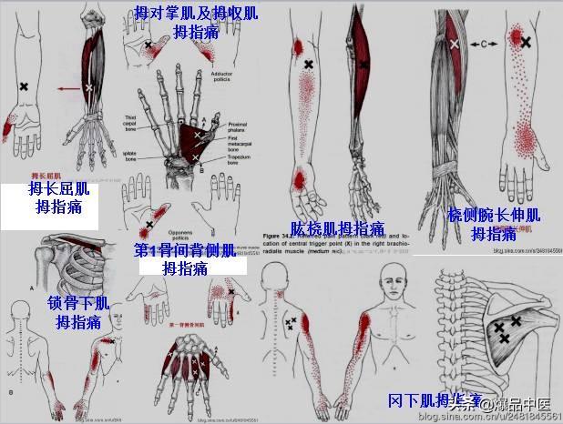 「图文并茂」全身激痛点