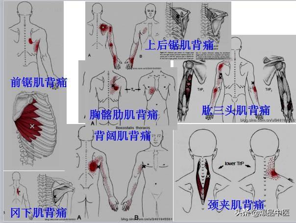 「图文并茂」全身激痛点