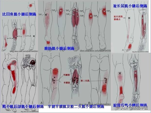 「图文并茂」全身激痛点