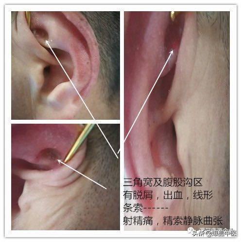 「精准」耳穴有玄机,3-5分钟祛顽疾