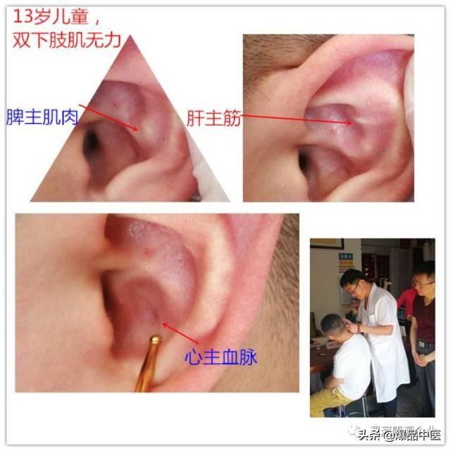 「精准」耳穴有玄机,3-5分钟祛顽疾