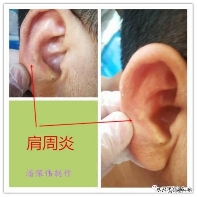 「精准」耳穴有玄机,3-5分钟祛顽疾