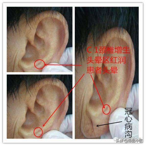 「精准」耳穴有玄机,3-5分钟祛顽疾