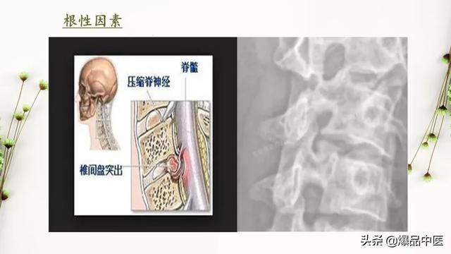 干货 | 手麻的辨构诊断