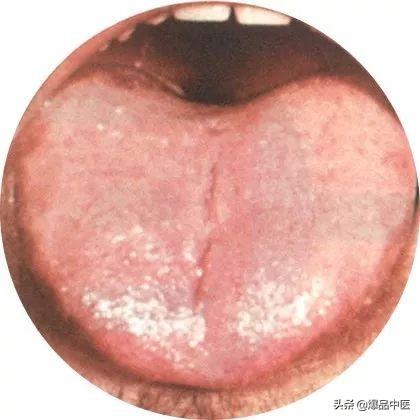 史上最全！高清舌诊图谱