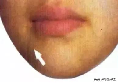 体表的青筋有话对你说！(建议收藏)