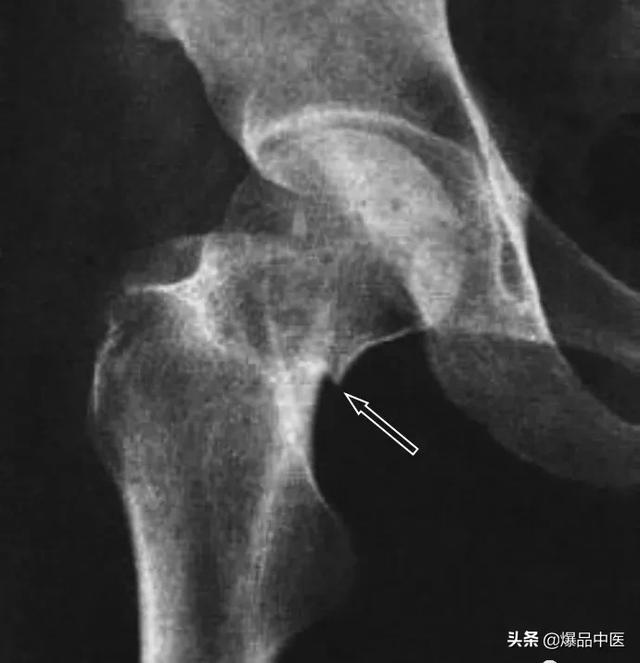 干货 | 110张经典X线片影像诊断