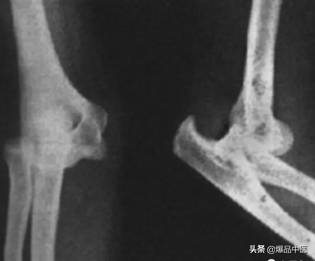 干货 | 110张经典X线片影像诊断