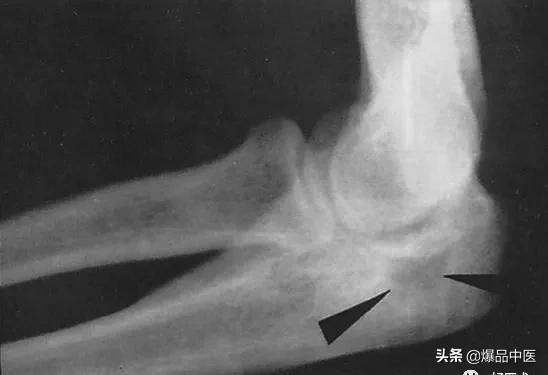 干货 | 110张经典X线片影像诊断