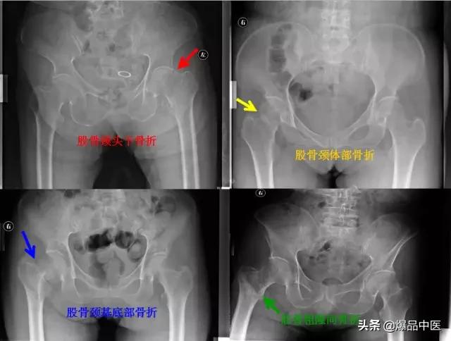 干货 | 110张经典X线片影像诊断
