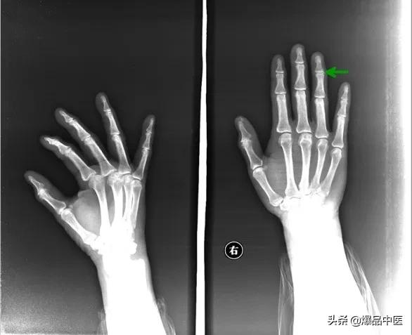 干货 | 110张经典X线片影像诊断