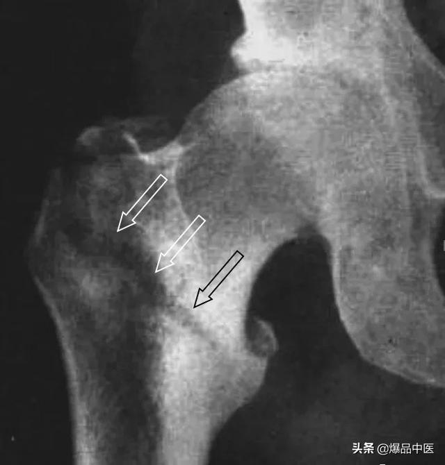 干货 | 110张经典X线片影像诊断
