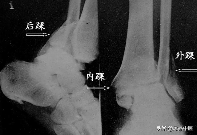 干货 | 110张经典X线片影像诊断