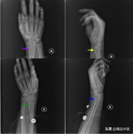 干货 | 110张经典X线片影像诊断
