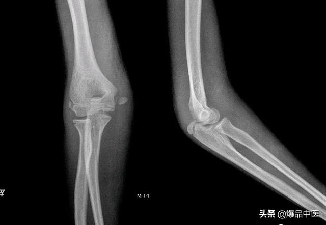 干货 | 110张经典X线片影像诊断
