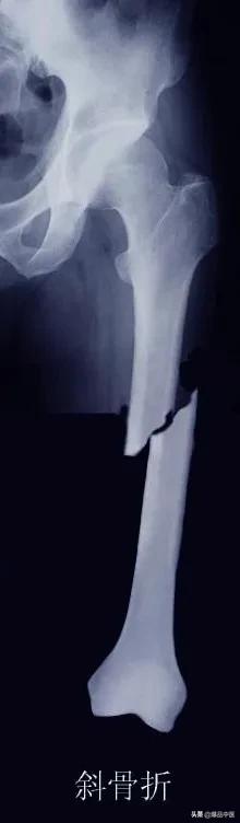干货 | 110张经典X线片影像诊断